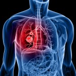 Beamion Lung-1: Zongertinib Emerges as a Promising Option in HER2 NSCLC